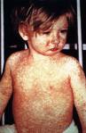 Newly imported measles virus shows up in Interior